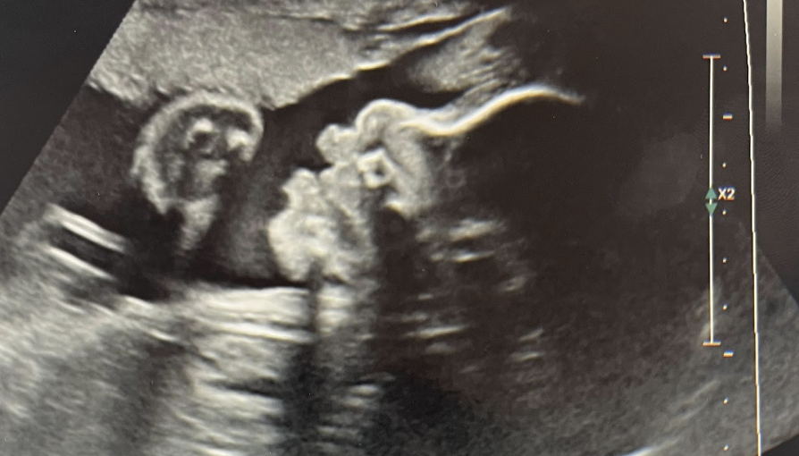 Prenatal ultrasound image of baby Renee at 25 weeks